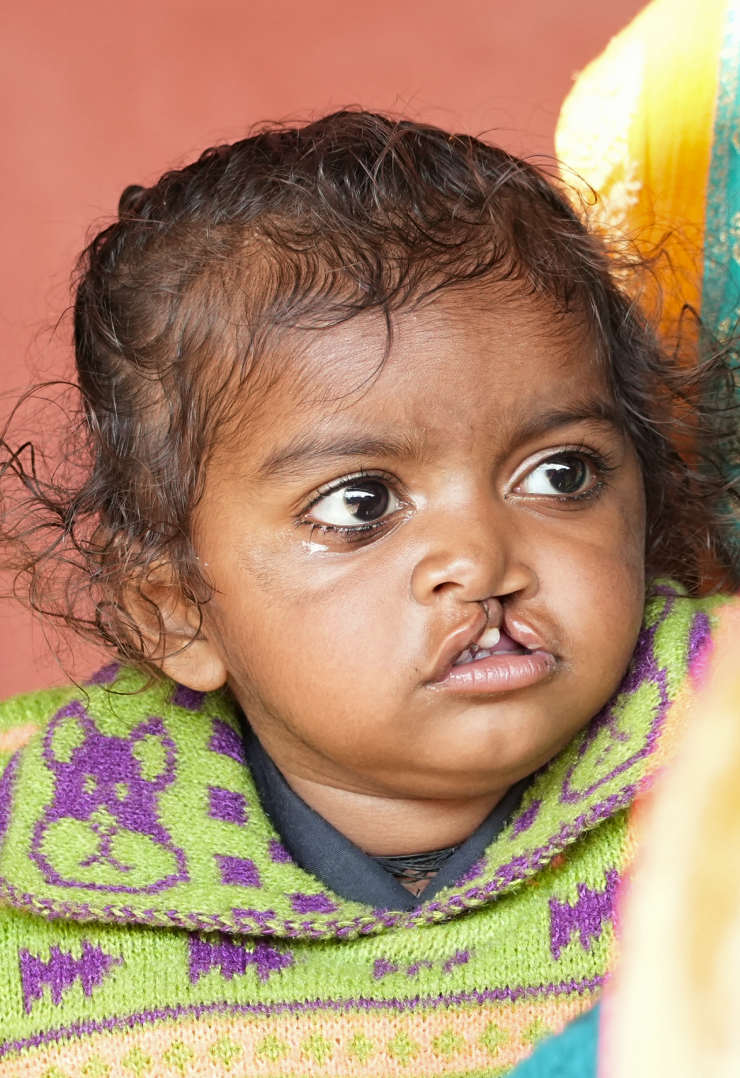 craniofacial surgery